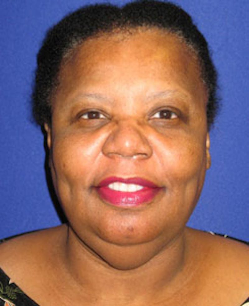 Facelift Before & After Gallery - Patient 308340 - Image 1