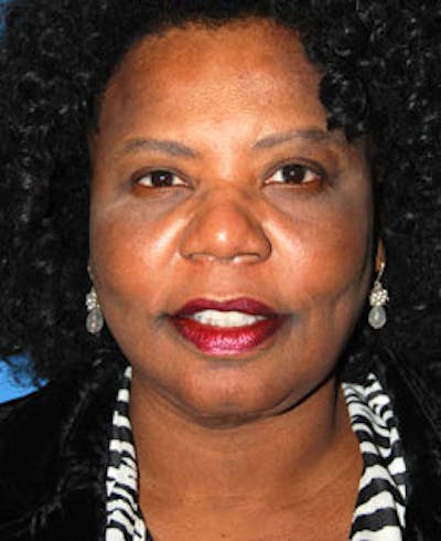 Facelift Before & After Gallery - Patient 308340 - Image 2