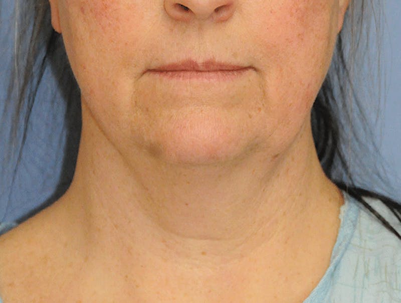 Facelift Before & After Gallery - Patient 148933 - Image 1