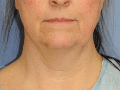 Facelift Before & After Gallery - Patient 148933 - Image 1