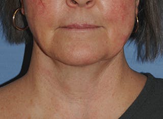 Neck Lift Before & After Gallery - Patient 378853 - Image 2