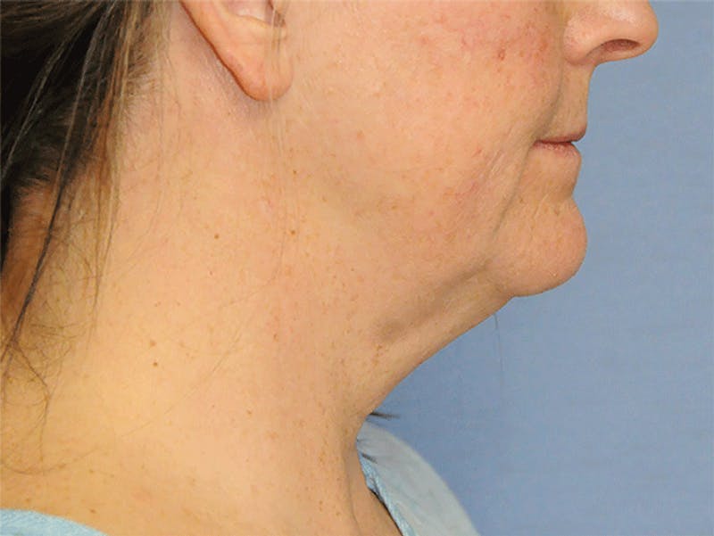 Facelift Before & After Gallery - Patient 148933 - Image 3