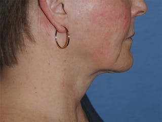 Neck Lift Before & After Gallery - Patient 378853 - Image 4