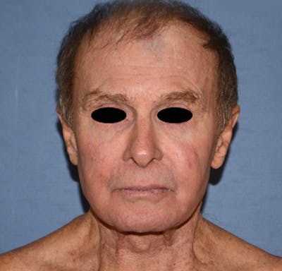 Facelift Before & After Gallery - Patient 142070 - Image 1