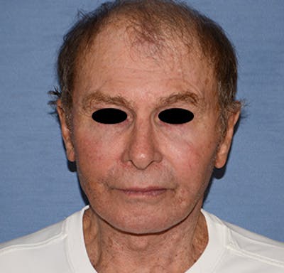 Facelift Before & After Gallery - Patient 142070 - Image 2