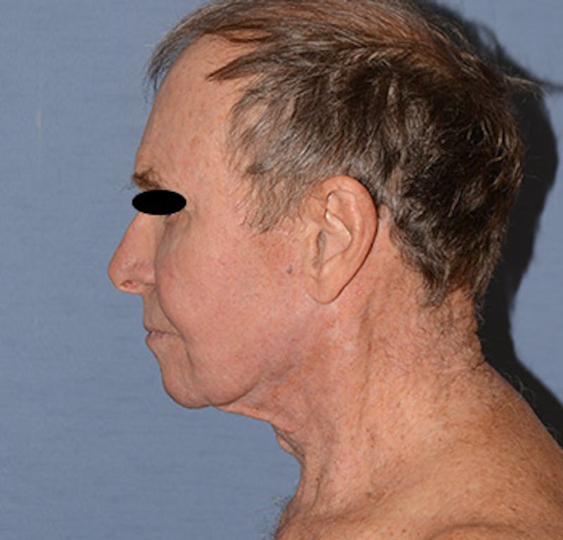 Facelift Before & After Gallery - Patient 142070 - Image 3