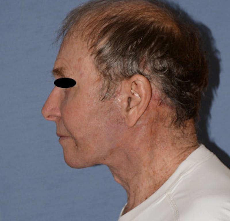 Facelift Before & After Gallery - Patient 142070 - Image 4