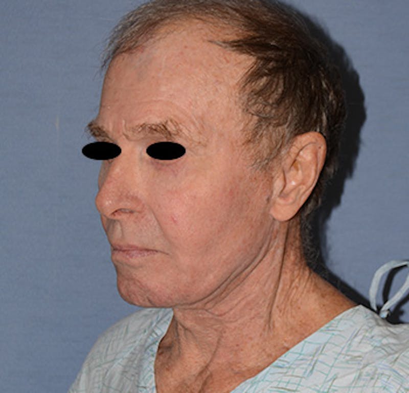 Facelift Before & After Gallery - Patient 142070 - Image 5