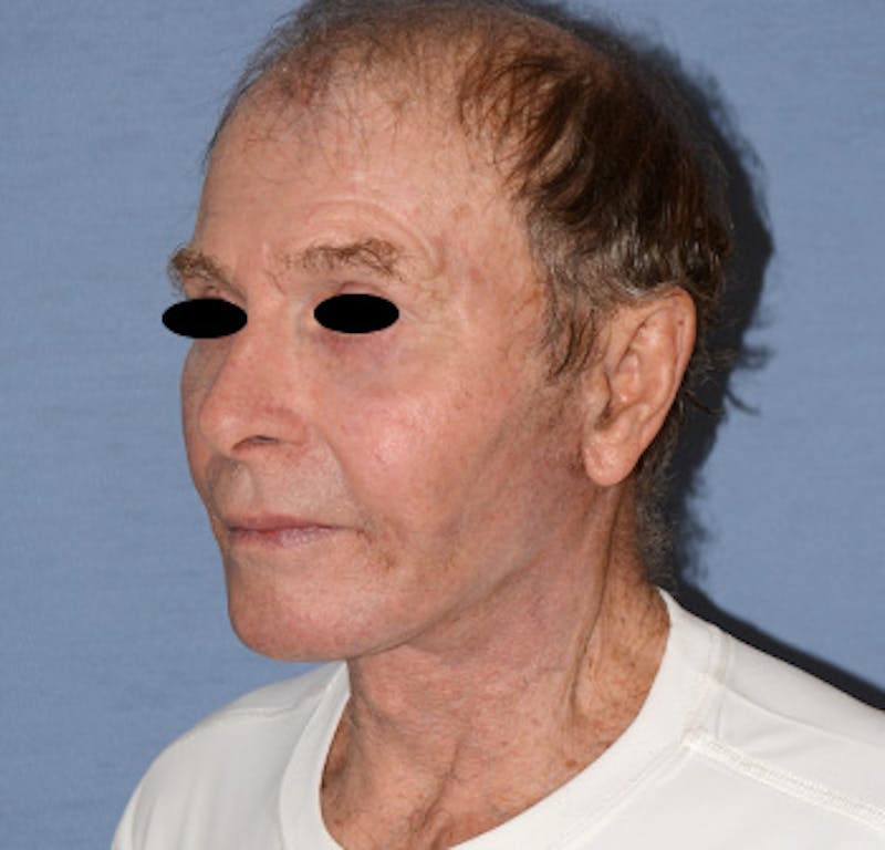 Facelift Before & After Gallery - Patient 142070 - Image 6