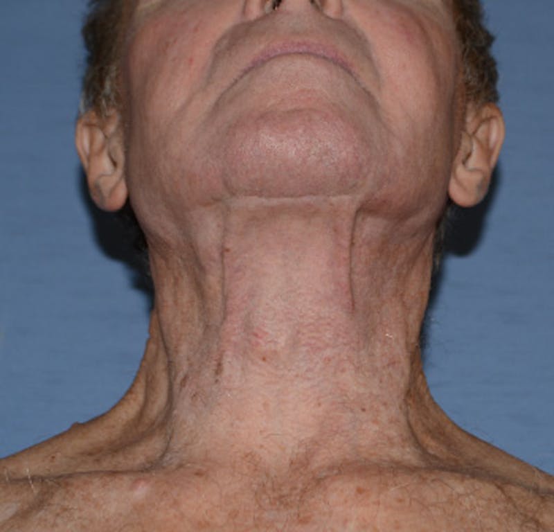 Facelift Before & After Gallery - Patient 142070 - Image 7