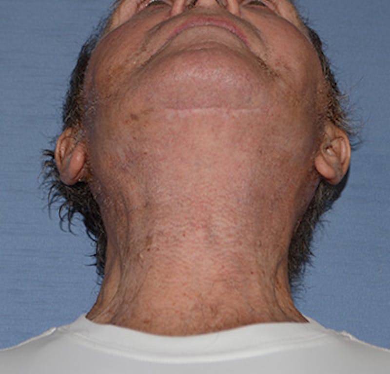 Facelift Before & After Gallery - Patient 142070 - Image 8