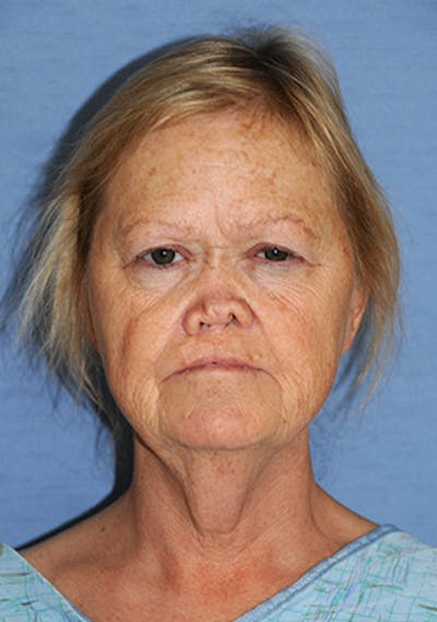 Facelift Before & After Gallery - Patient 315261 - Image 1