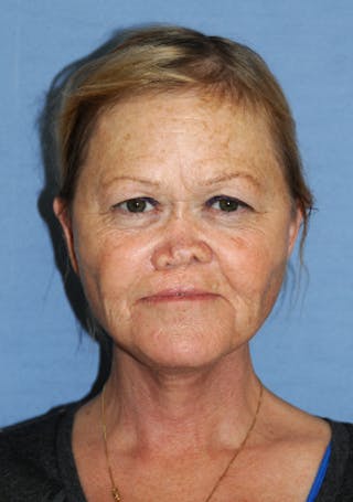 Neck Lift Before & After Gallery - Patient 424216 - Image 8
