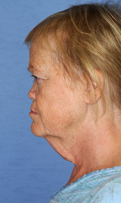 Neck Lift Before & After Gallery - Patient 424216 - Image 1