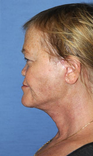 Neck Lift Before & After Gallery - Patient 424216 - Image 2