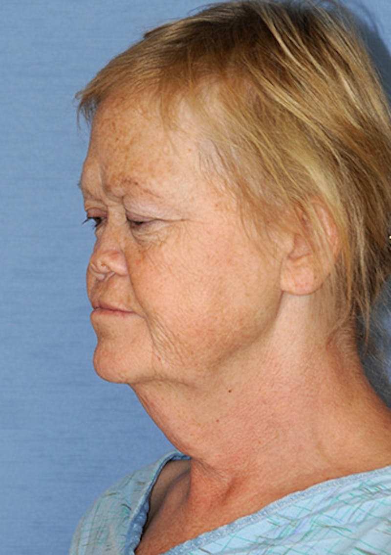 Facelift Before & After Gallery - Patient 315261 - Image 5