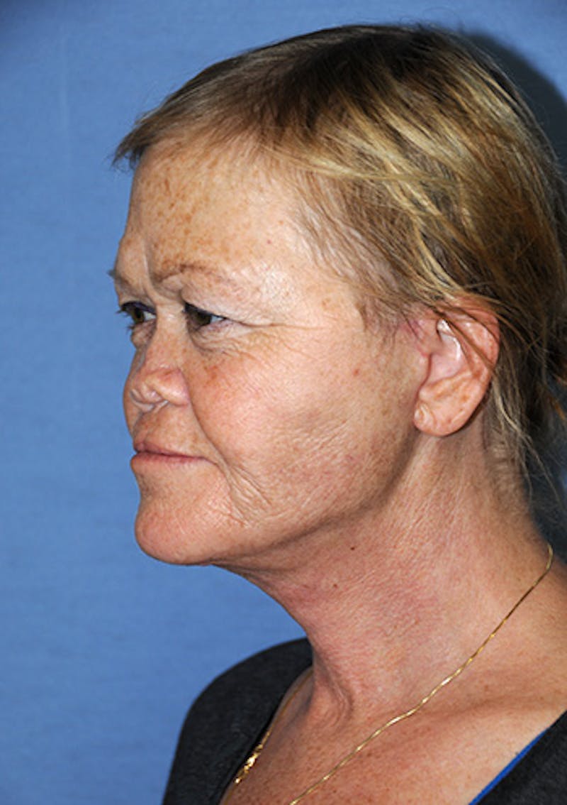 Facelift Before & After Gallery - Patient 315261 - Image 6