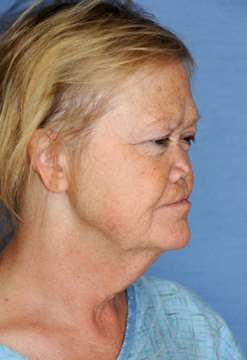 Facelift Before & After Gallery - Patient 315261 - Image 7