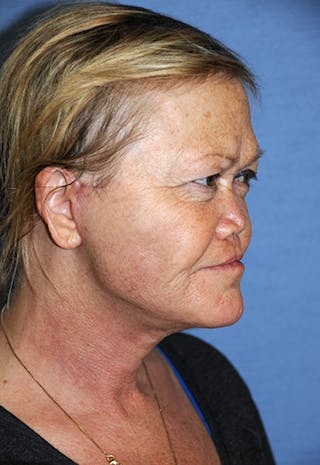 Neck Lift Before & After Gallery - Patient 424216 - Image 6