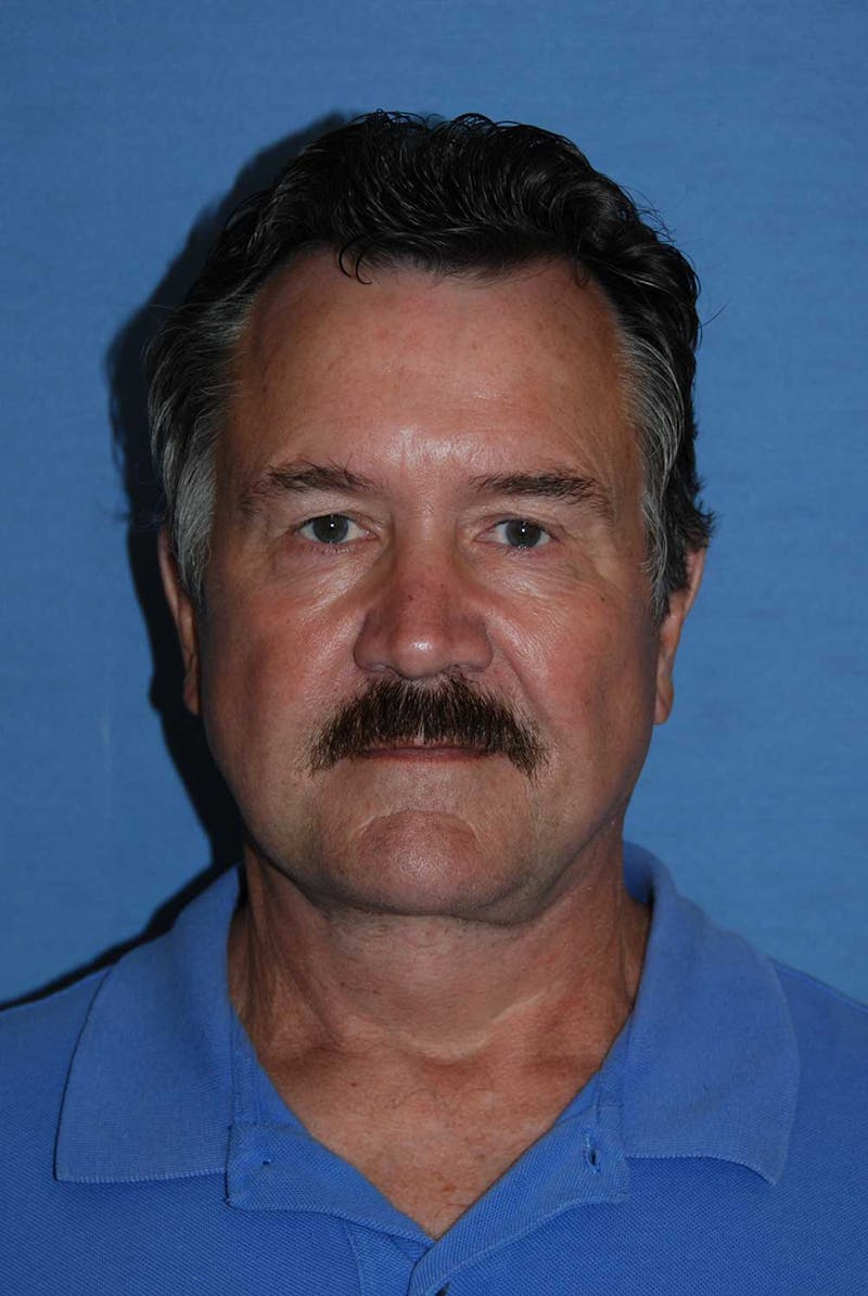 Facelift Before & After Gallery - Patient 782412 - Image 2