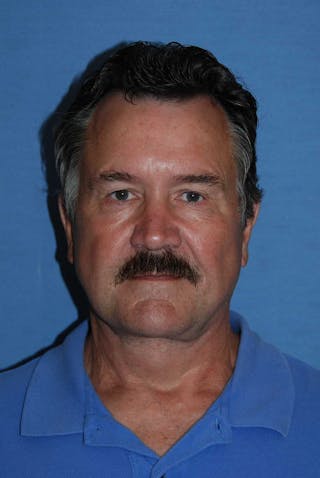 Facelift Before & After Gallery - Patient 782412 - Image 2