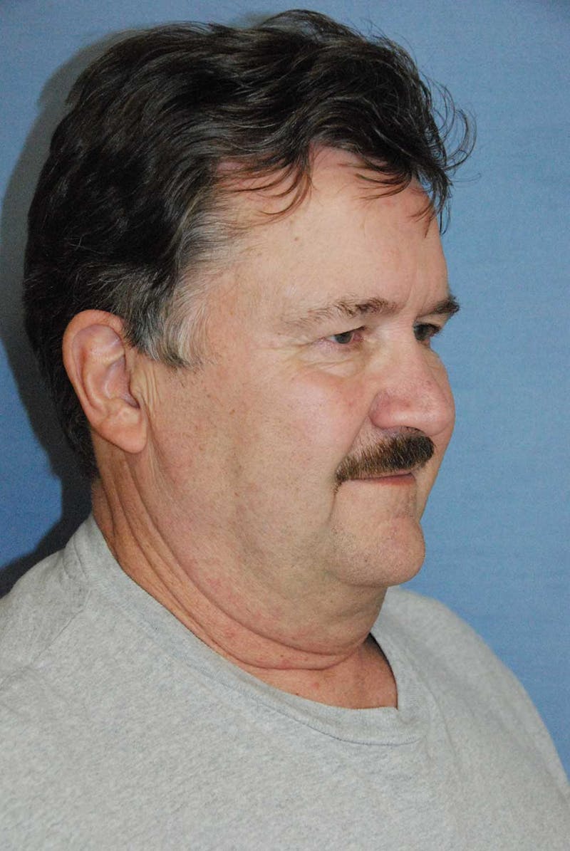 Facelift Before & After Gallery - Patient 782412 - Image 3
