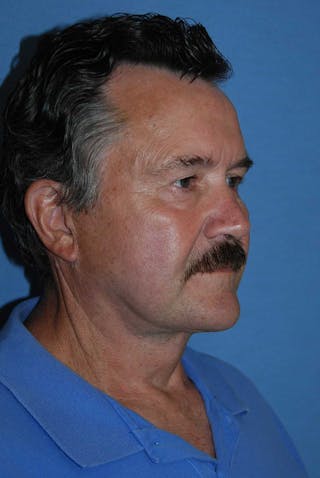 Facelift Before & After Gallery - Patient 782412 - Image 4