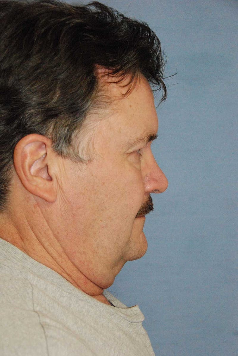 Facelift Before & After Gallery - Patient 782412 - Image 5