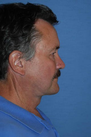 Facelift Before & After Gallery - Patient 782412 - Image 6