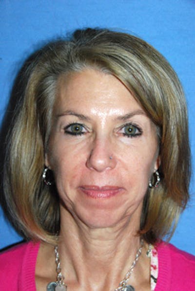 Facelift Before & After Gallery - Patient 104016 - Image 1