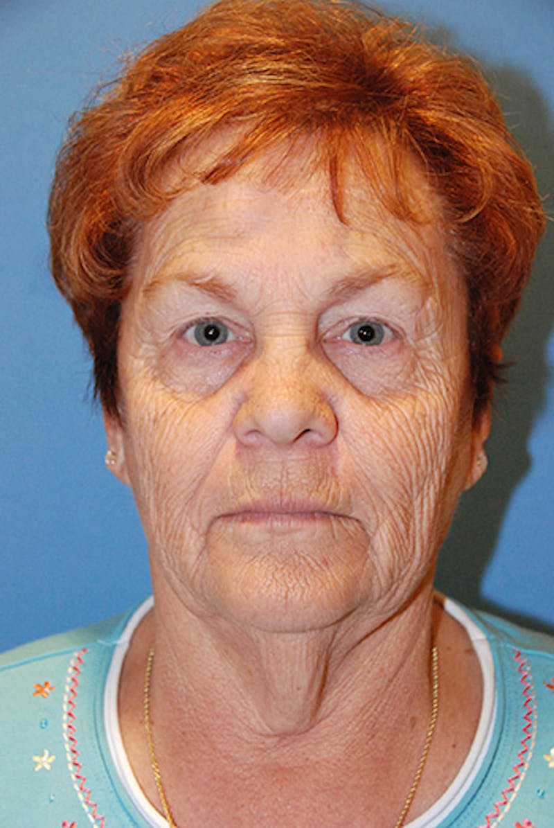 Facelift Before & After Gallery - Patient 104681 - Image 1