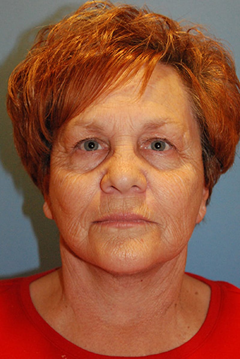 Facelift Before & After Gallery - Patient 104681 - Image 2