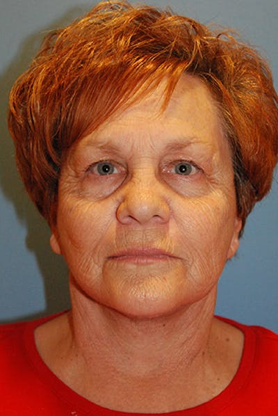 Facelift Before & After Gallery - Patient 104681 - Image 2