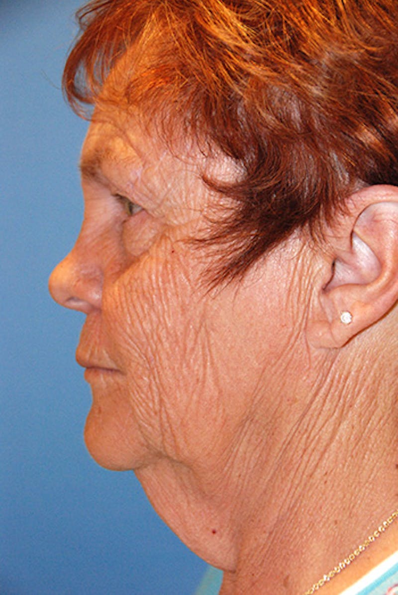 Facelift Before & After Gallery - Patient 104681 - Image 3