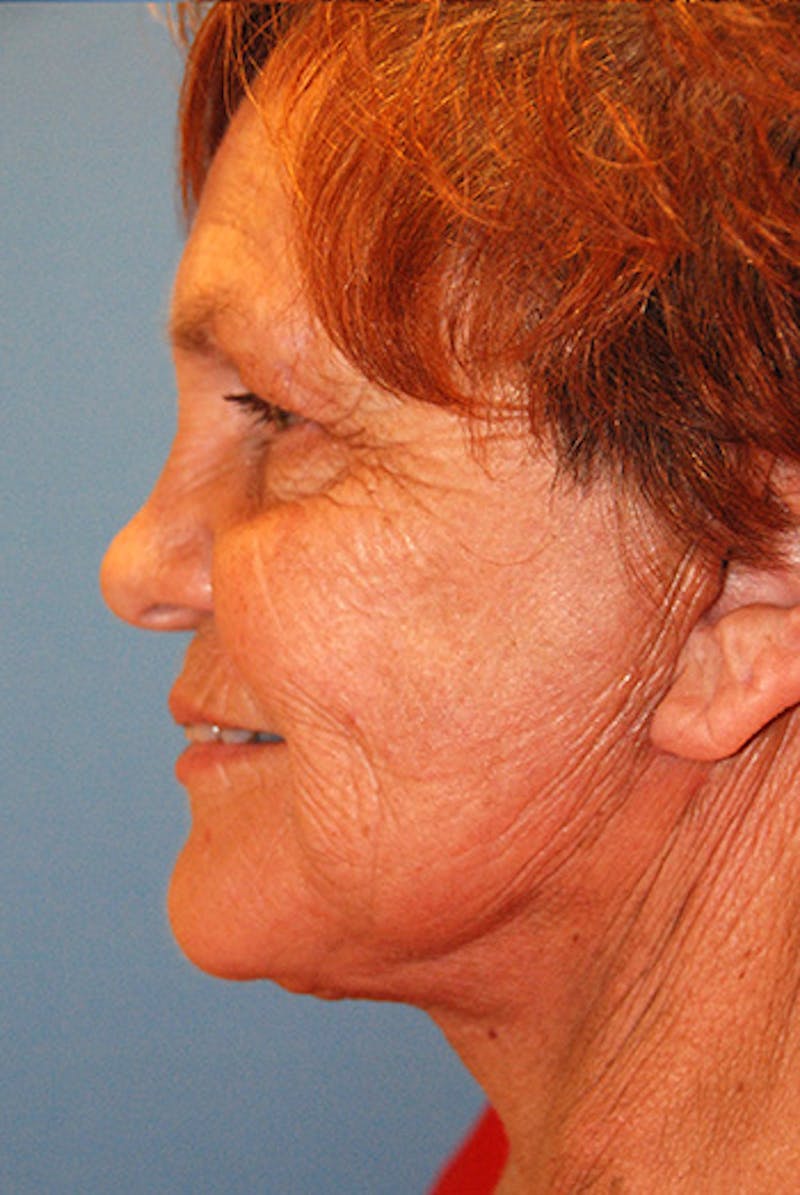 Facelift Before & After Gallery - Patient 104681 - Image 4