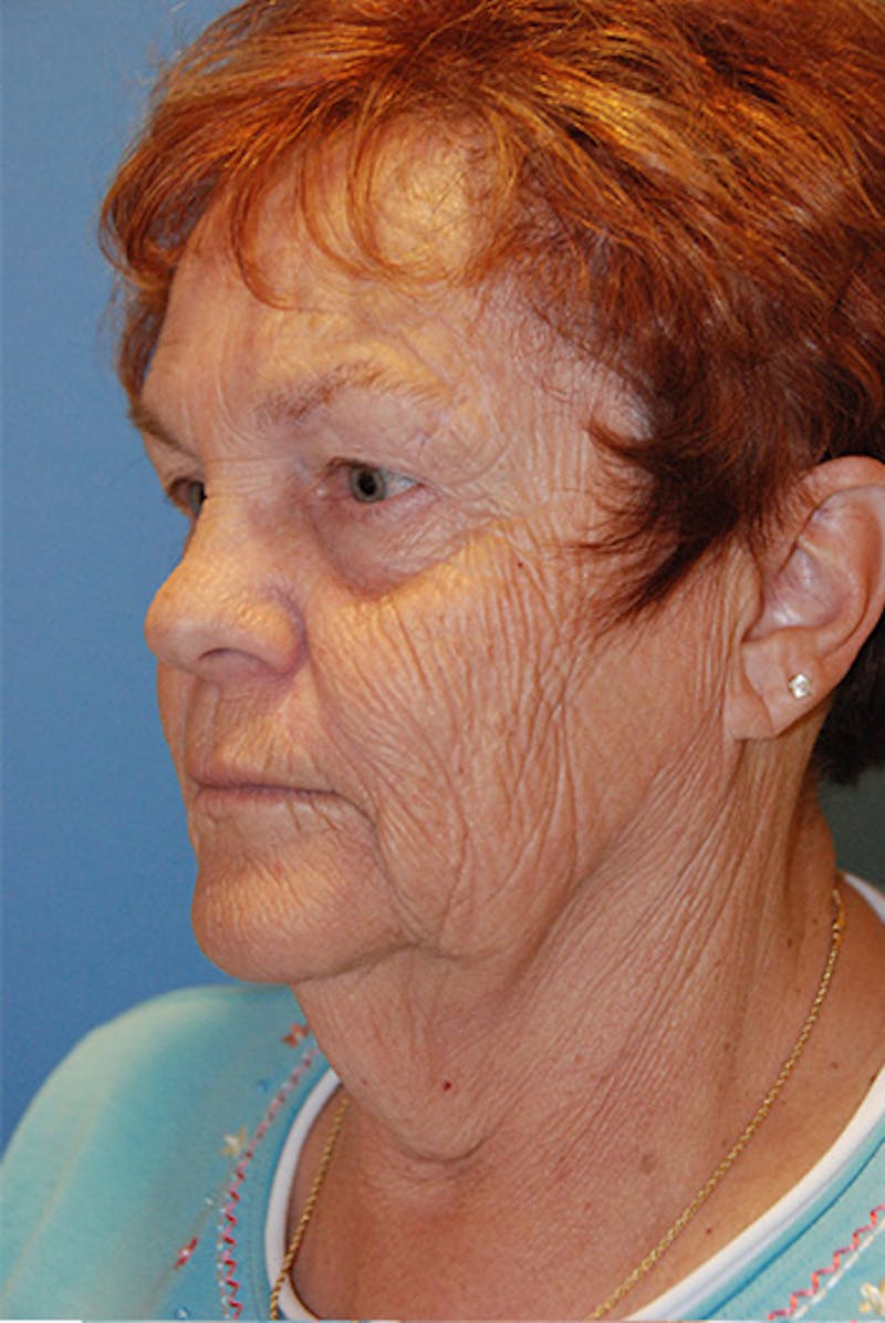 Facelift Before & After Gallery - Patient 104681 - Image 5