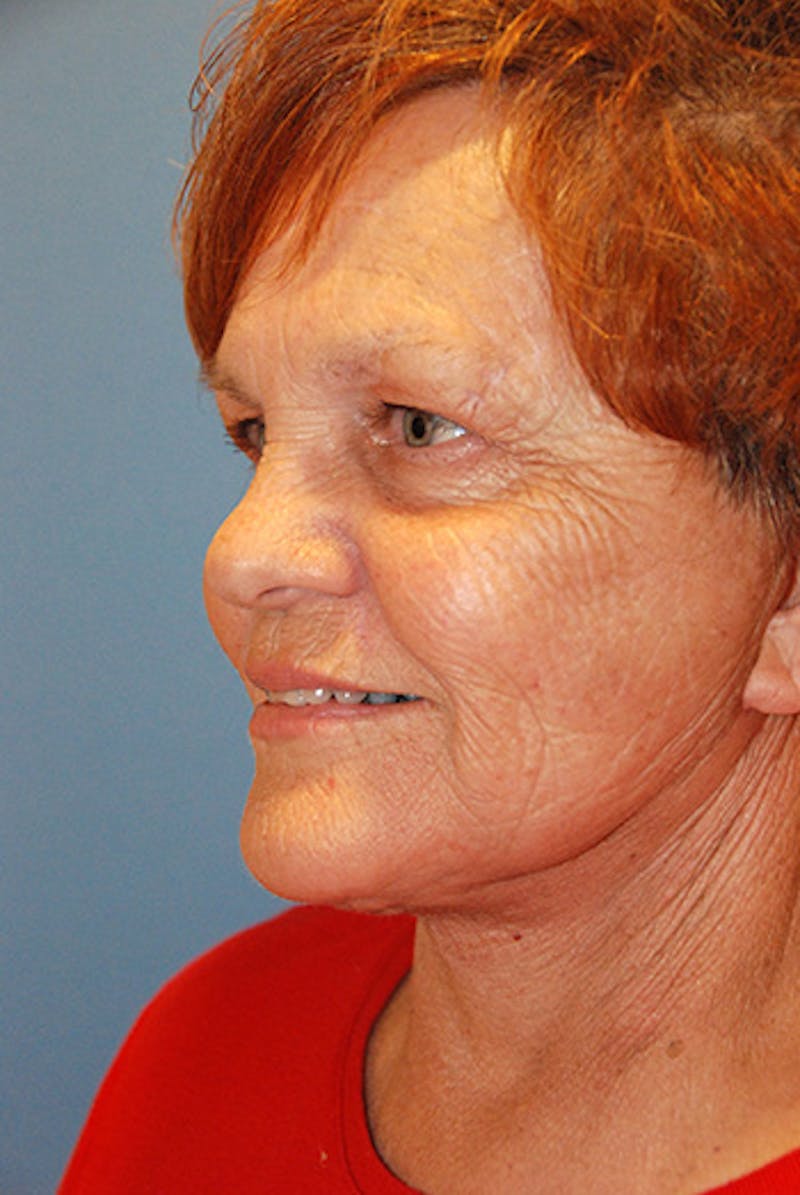 Facelift Before & After Gallery - Patient 104681 - Image 6