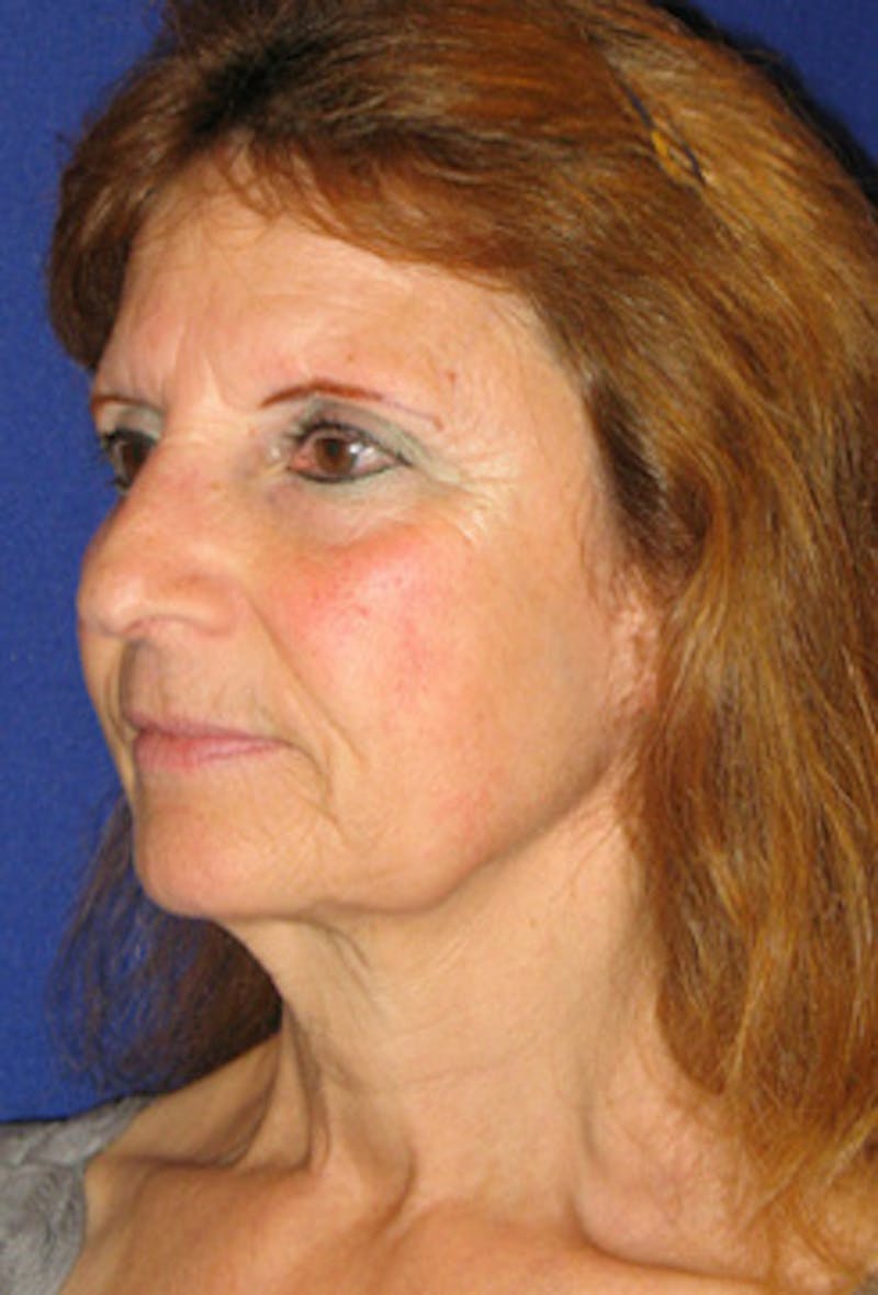 Facelift Before & After Gallery - Patient 203313 - Image 1
