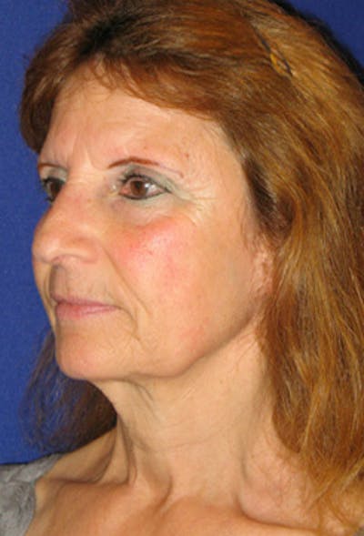 Facelift Before & After Gallery - Patient 203313 - Image 1