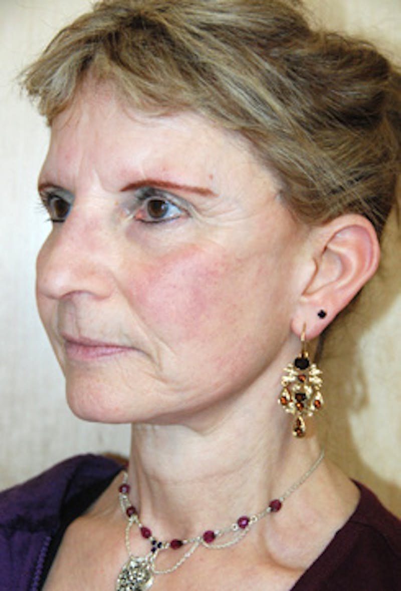 Facelift Before & After Gallery - Patient 203313 - Image 2