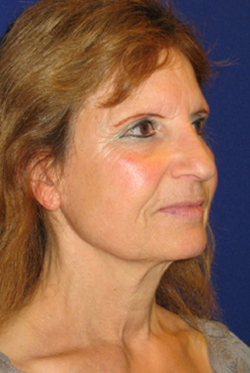 Facelift Before & After Gallery - Patient 203313 - Image 3