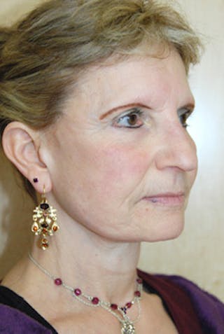 Facelift Before & After Gallery - Patient 203313 - Image 4
