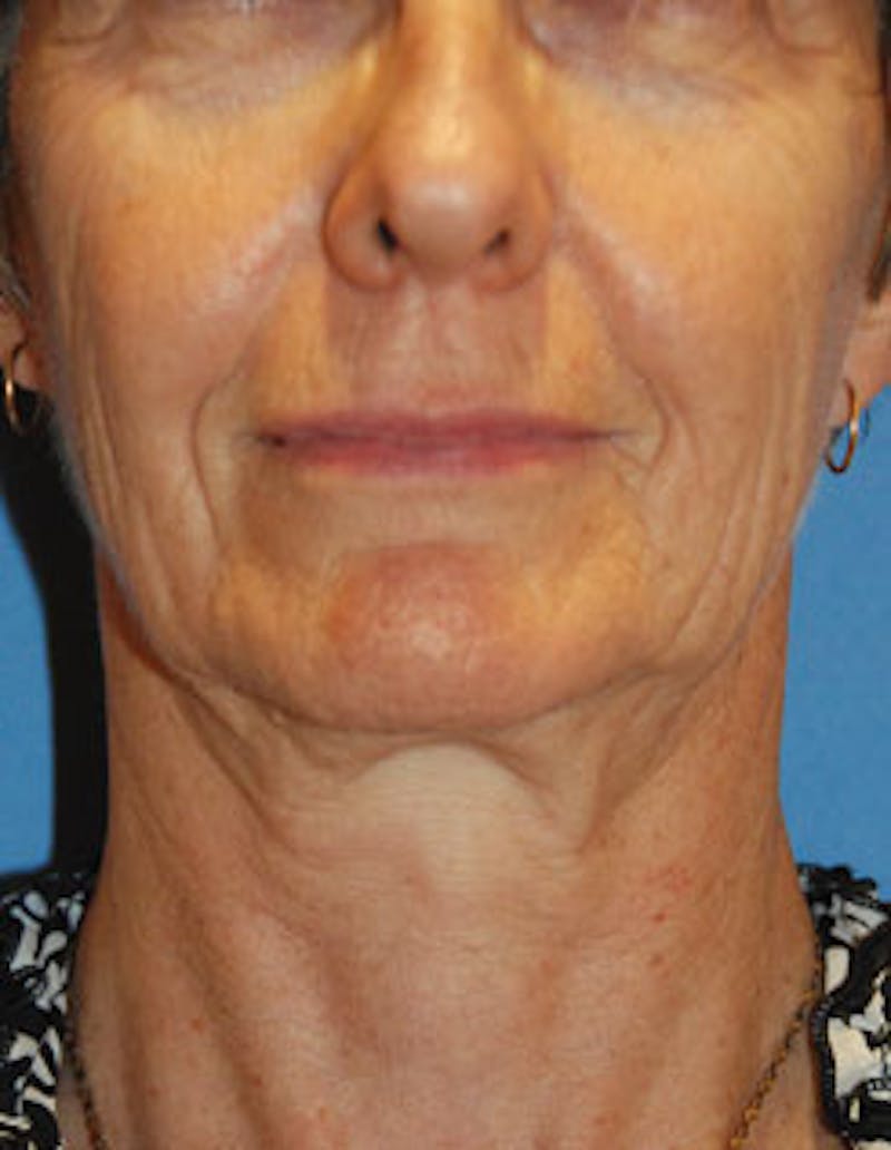 Facelift Before & After Gallery - Patient 564653 - Image 1