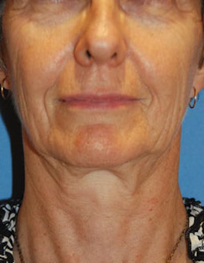 Facelift Before & After Gallery - Patient 564653 - Image 1