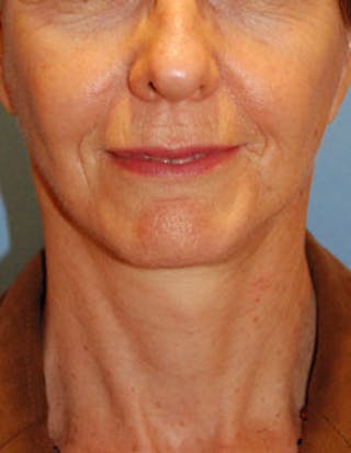 Facelift Before & After Gallery - Patient 564653 - Image 2