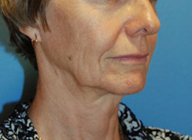 Facelift Before & After Gallery - Patient 564653 - Image 3