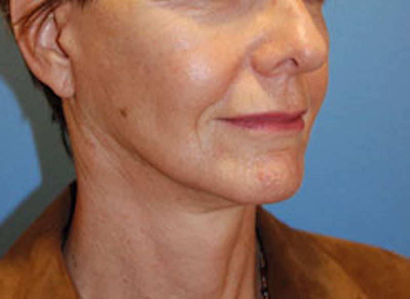 Facelift Before & After Gallery - Patient 564653 - Image 4