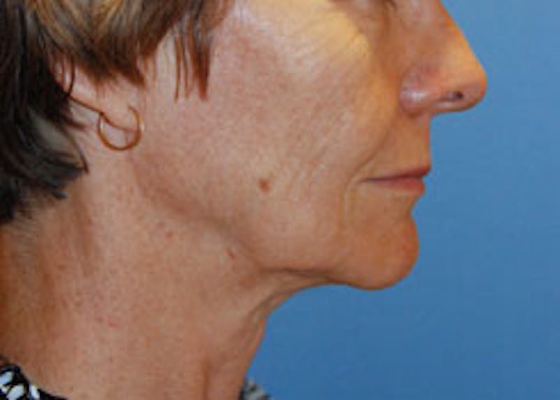 Facelift Before & After Gallery - Patient 564653 - Image 5