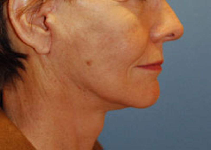 Facelift Before & After Gallery - Patient 564653 - Image 6