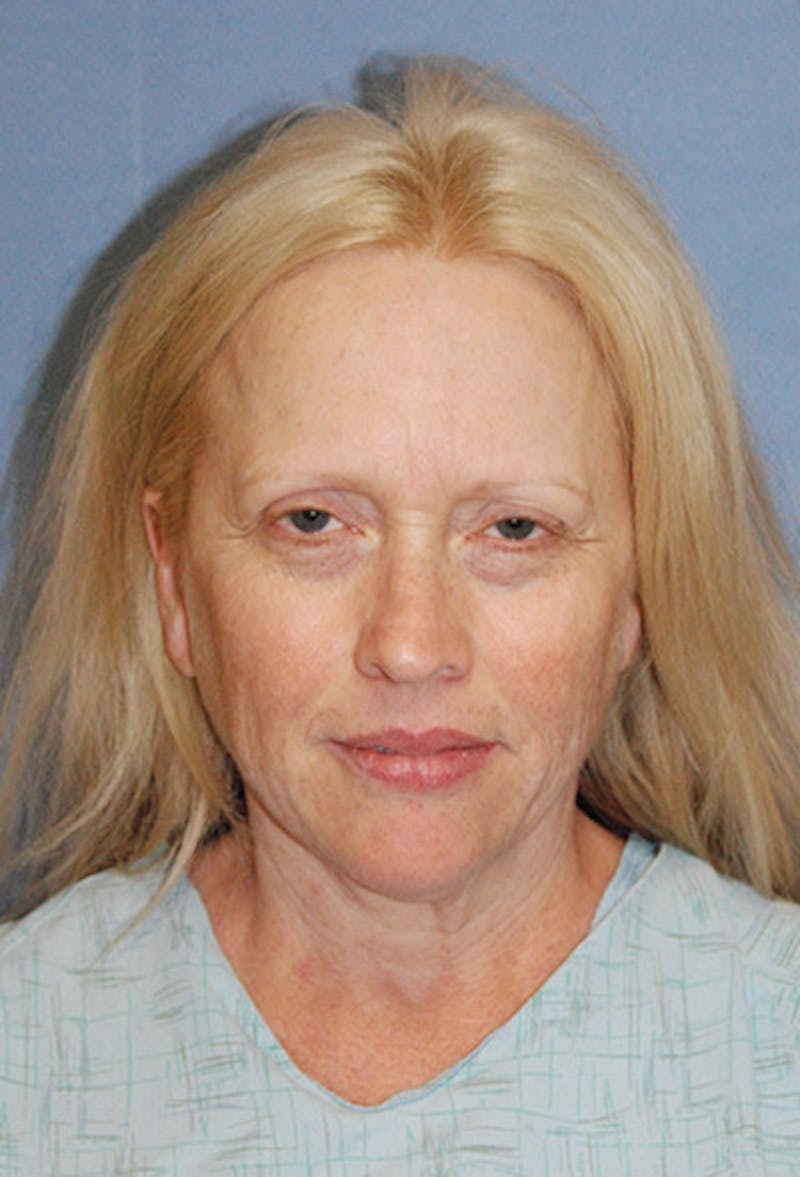 Facelift Before & After Gallery - Patient 904096 - Image 1